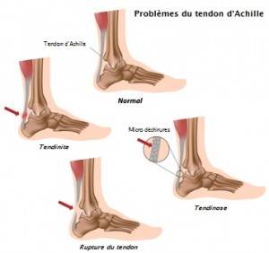 Achilles tendon problems, eps8