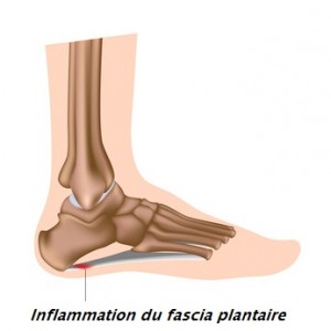 Plantar fasciitis, foot problem, eps8